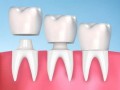 Điều trị nội nha - Chữa tủy răng