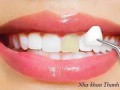 Nhổ răng khôn công nghệ Piezotome
