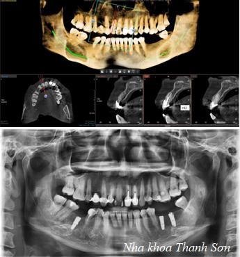 Cấy Ghép IMPLANT