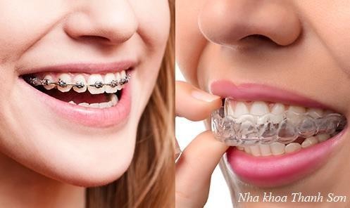 Mắc cài niềng răng truyền thống và khay niềng Invisalign